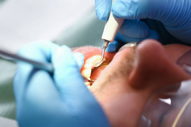 Best Emergency Root Canal Treatment in Tipp City, OH